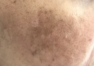 Hyperpigmentation